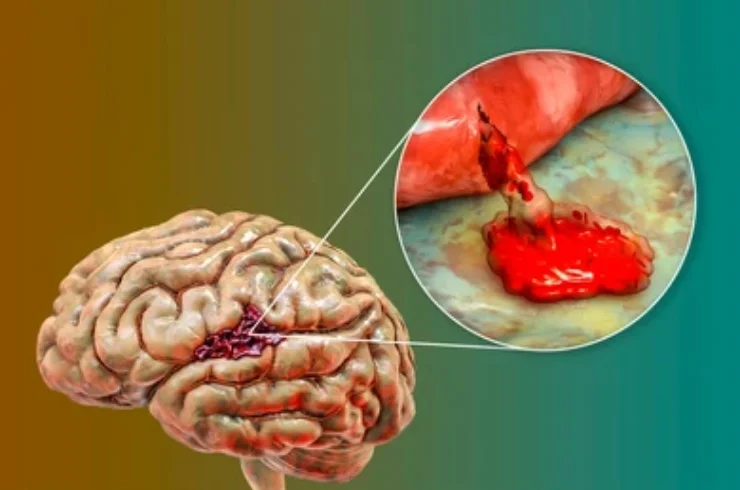 Brain Haemorrhage-----15