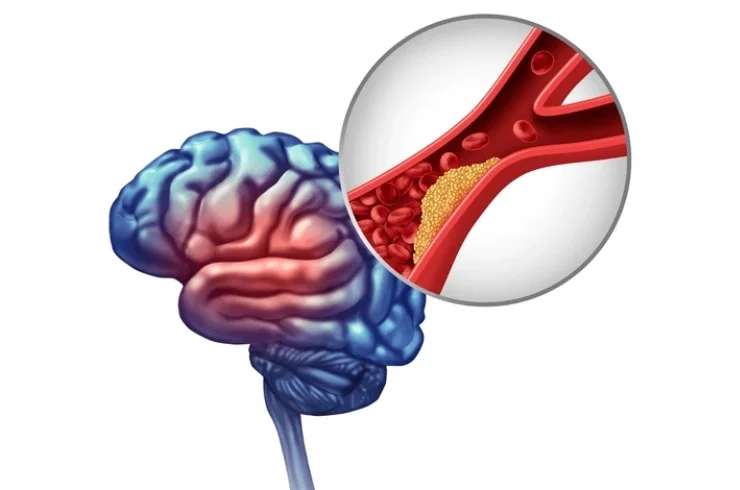 Brain Stroke-------15